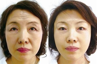 10MHZ Radio Frequencies Acne Removal Machine With Non Invasive