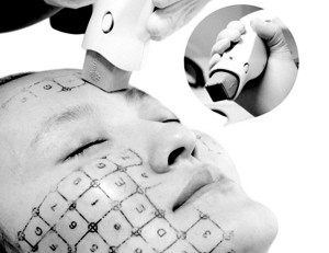 10MHZ Radio Frequencies Acne Removal Machine With Non Invasive