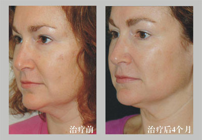 10MHZ Radio Frequencies Acne Removal Machine With Non Invasive