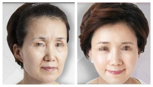 RF Skin Rejuvenation Machine 10.4 Inch Square Screen Neck Skin