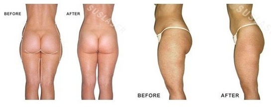 Master GS8.0 Ultrasonic Cavitation Slimming Machine Weight-Losing