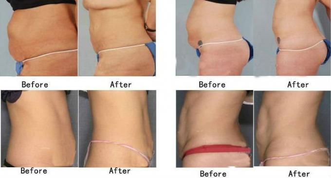 좋은 결과를 가진 직업적인 zerona 레이저 lipo